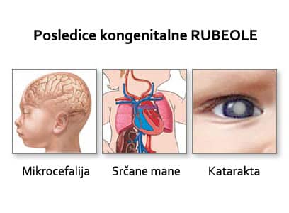 rubeola